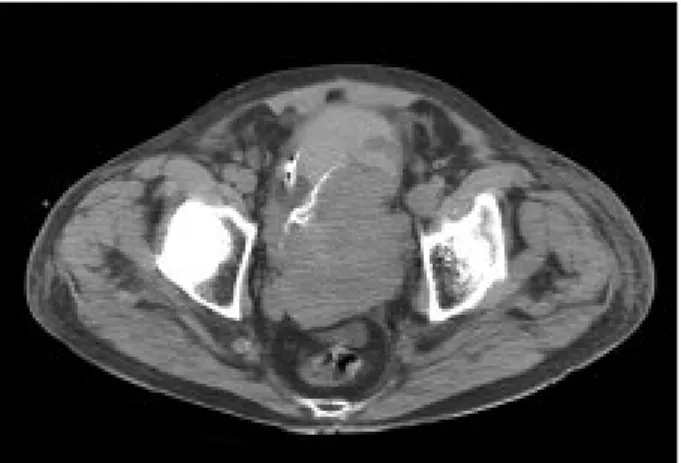 Figura 1. Imagen axial de la tomografía computarizada abdominal sin contraste, observando vejiga con globo de sonda en su interior y pared muy engrosada con masa parcialmente calcificada mal delimitada que no presenta plano de separación graso con estructu