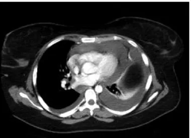Figura 1. Tomografía computarizada: derrame pericárdico, derrame pleural bilateral.