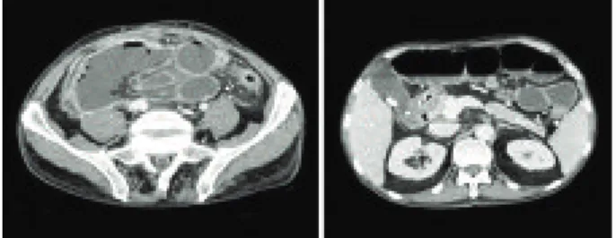 Figura 1. Tomografía computarizada abdominal que muestra oclusión intestinal con perforación de asa ileal y gran colección abdominal.