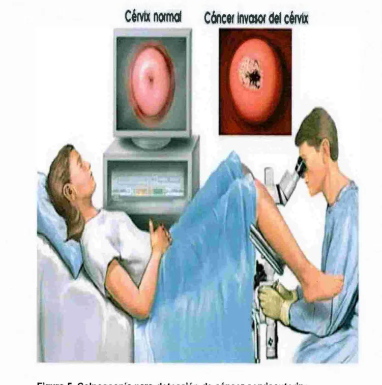 Figura 5.  Colposcopía para  detección  de  cáncer cervicouterino. 