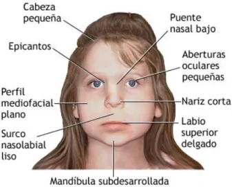 Figura 1. Rasgos faciales característicos asociados al SAF 