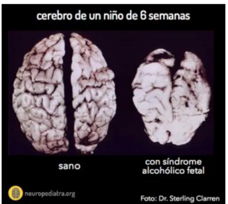 Figura 2. Cerebro de un niño de 6 semanas sano vs un niño con SAF. 