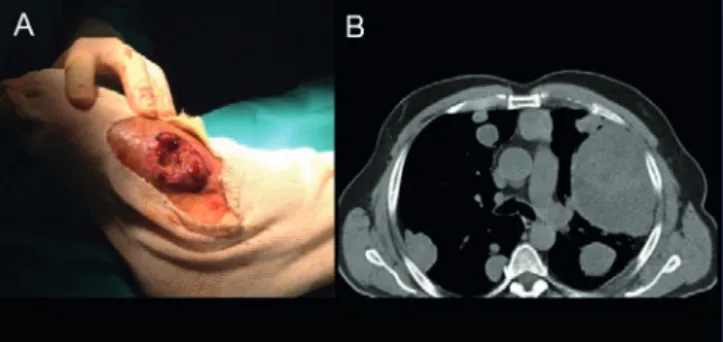 Figura 1. A: Hallazgos operatorios: lesión excreciente con sangrado  en sábana. B: Corte transversal de tomografía computarizada de tórax en  el que se observan metástasis sarcomatosas pulmonares (patrón en suelta  de globos).