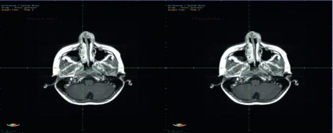 Figura 4. Corte axial de RM de cráneo, visualizando tumor en ala nasal izquierda, sin difusión tumoral.