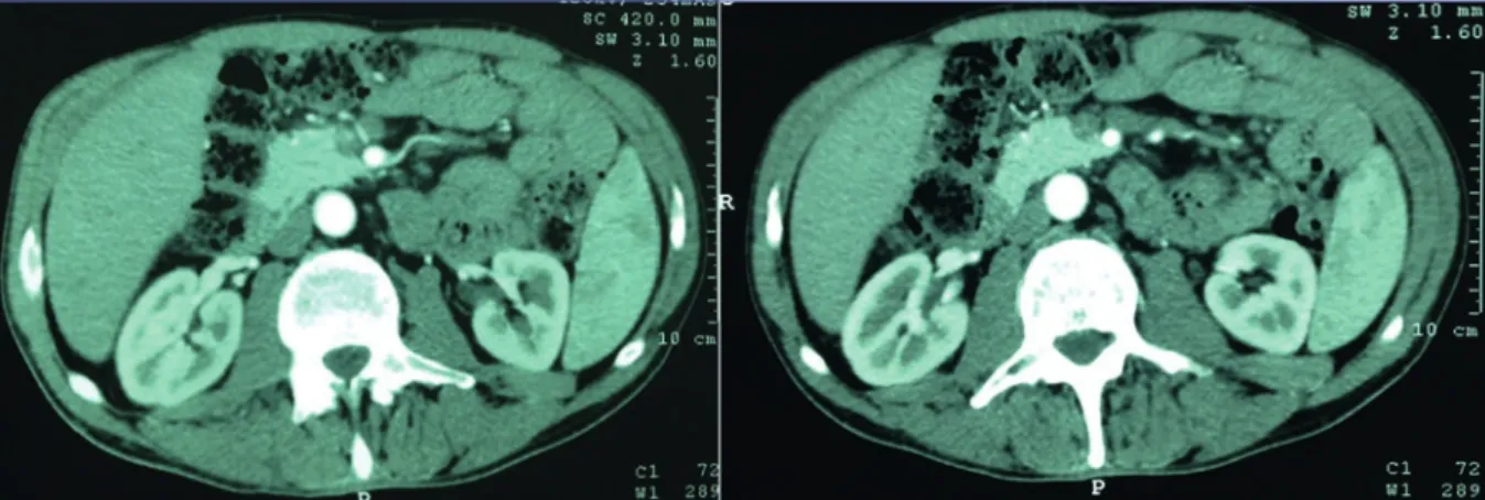 Figura 2. Tomografía helicoidal de abdomen con doble contraste 11 meses después del tratamiento inicial