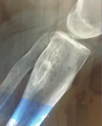 figura 1. Tumor óseo.