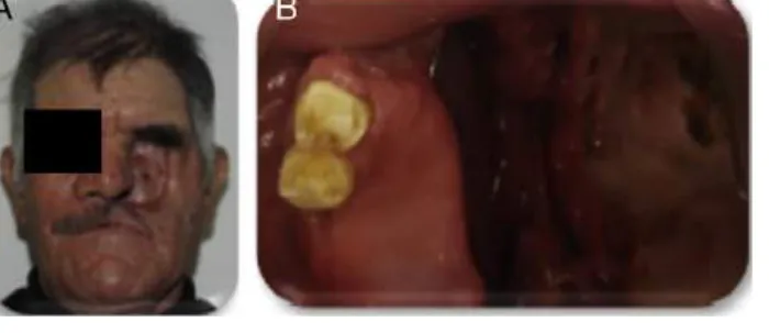Figura 3 Posoperatorio a un mes. A) Defecto facial. B) Defecto maxilar.