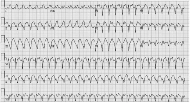 Fig. 2. 12-lead ECG showing monomorphic VT. This ECG shows a regular monomorphic tachycardia with a wide QRS of 160 milliseconds and an atypical QRS morphology in the precordial leads