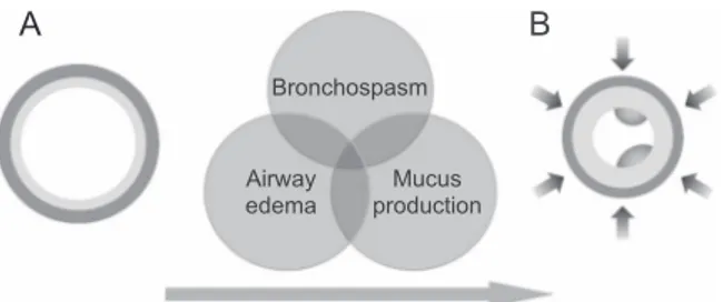 Fig. 1. Schematic demonstrating asthma pathophysiology. Note the change in the cross-sectional airway from a normal airway (A) to an asthma bronchiole (B), with smooth muscle  bronchocon-striction, mucosal edema, and mucus clinging to airway walls.