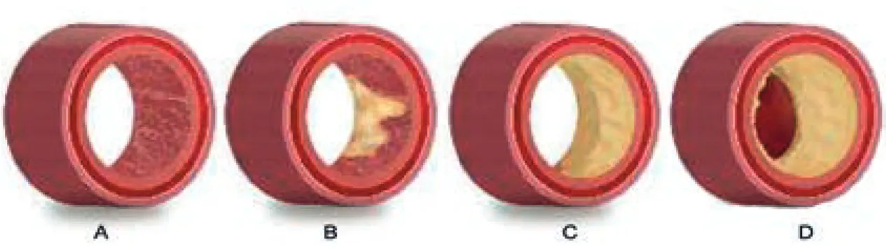 Figura 1  Secuencia progresiva de la formación de una placa aterosclerosa compleja. A) Arteria normal: muestra las  tres capas que la conforman, la íntima también llamada endotelio, responsable de la función endotelial; la media, que  se constituye de célu