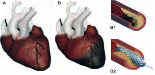 Figura 2  El fenómeno aterotrom- aterotrom-bótico se debe a la presencia  de ateroma y trombo en una  arteria coronaria epicárdica, al  obstruirse 100% causa un infarto  agudo de miocardio