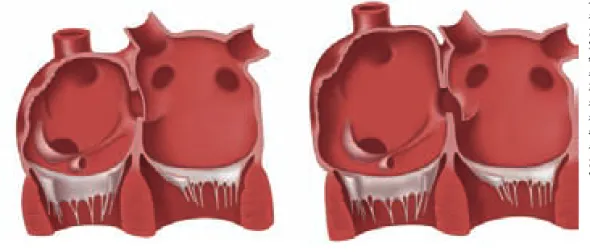 Figure 6-4.  LEFT IMAGE, Normal atrial size and  anatomy. In about one quarter of individuals,  there is patency of the foramen ovale