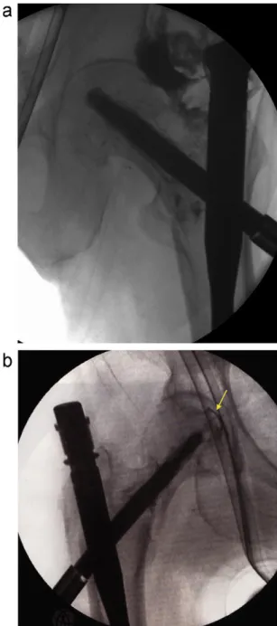 Fig. 2. The side opening cannula which is used to inject the cement.