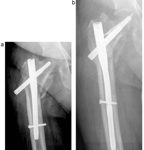 Fig. 7. (a) The gamma nail failed in this unstable pertrochanteric fracture 6 weeks after surgery