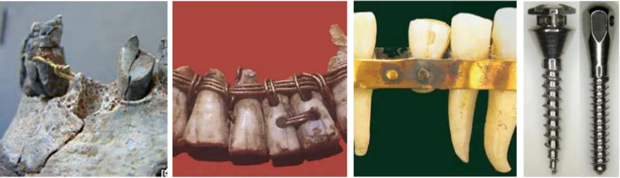 Figura 1. Imagen 1: Dientes de madera unidos entre sí por alambre de oro (romanos)  Imagen 2: Prótesis dental fenicia ( 400-600 a
