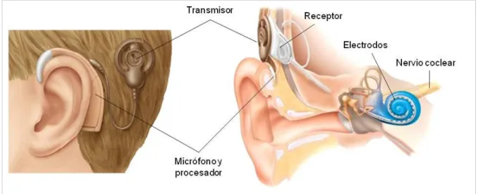 Figura  I7.  Estructura  de  un  implante  coclear.  El  micrófono,  colocado  en  el  pabellón  auditivo,  recoge  los  sonidos  y  un  procesador  los  transforma  en  señales  que  envía  a  un  transmisor