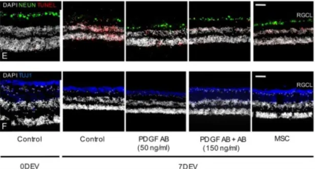 Fig 9. Imágenes ampliadas y representativas de RGCs (NeuN - verde o TUJ1 - azul) en explantes de retina  humanos con células apoptóticas marcadas de rojo
