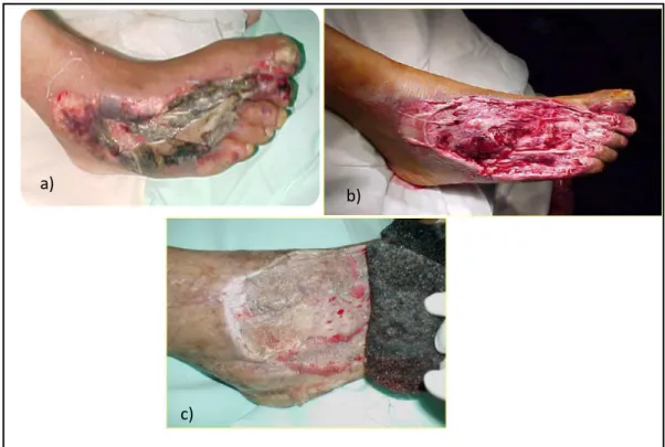 Figura 3: evolución de una herida por aplastamiento utilizando sistema VAC a) al ingreso,  b) desbridamiento previo a la terapia y c) 2ª cura 4º día post-terapia 35 