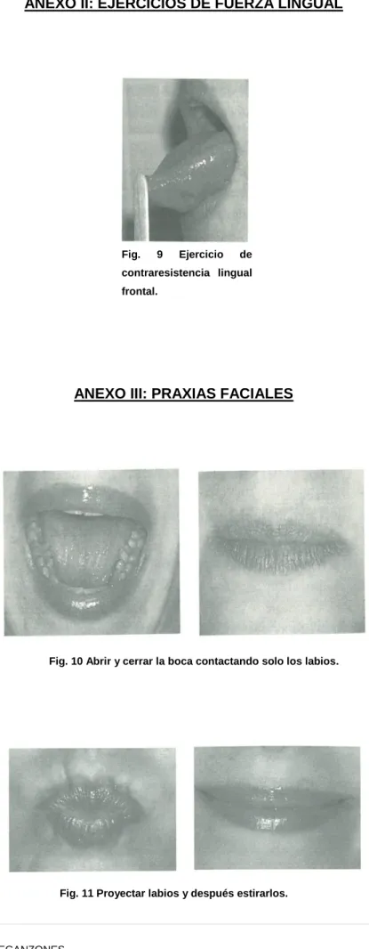 Fig.  9  Ejercicio  de  contraresistencia  lingual  frontal. 