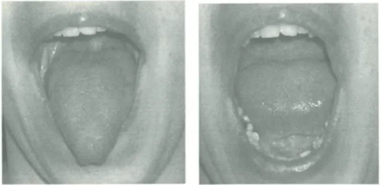 Fig. 16 Sacar y meter la lengua sin rozar los dientes. 