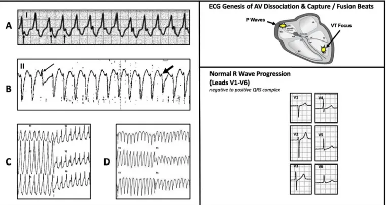Fig. 4. Electrocardiographic ﬁndings suggestive of ventricular tachycardia. A. Atrioventricular dissociation