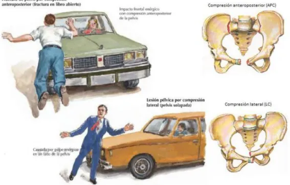 Figura  16:  Mecanismo  de  compresión  anteroposterior  y  lateral.  Netter  F.H.  Atlas  práctico  anatomía y ortopedia, 2011 6