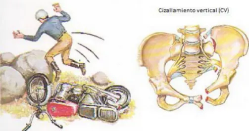 Tabla 2: Clasificación de Tile. Fractures of the pelvic and the acetabulum, 2003 7