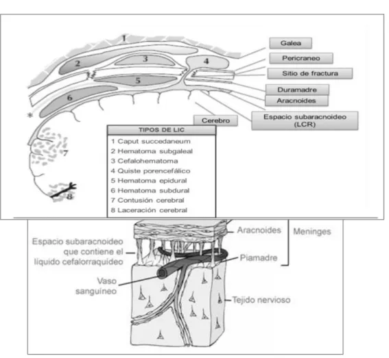 Figura 2. Anatomía de las cubiertas encefálicas y tipos de lesión intra y  extracraneal 