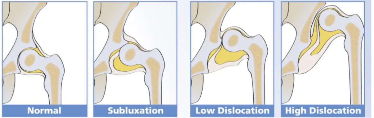 Figura 1. Imagen comparativa entre una cadera normal y caderas subluxada y luxada. 