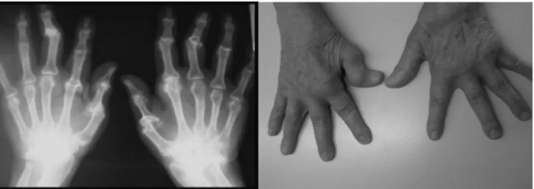 FIGURE 2 Erosive RA. RA is the most common inflammatory arthritis and affects small and large joints of the hands and feet