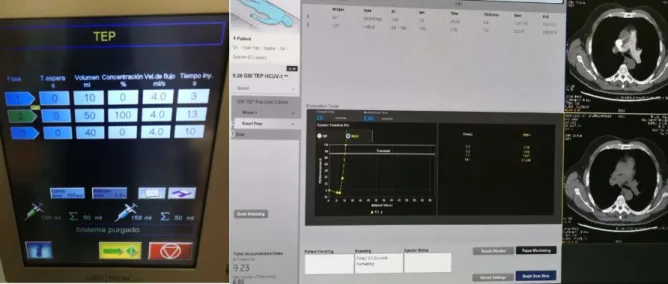 Figura 8. Técnica de inyección del contraste. Imagen derecha: pantalla del inyector con el  protocolo  establecido;  imagen  izquierda:  pantalla  durante  la  inyección  del  contraste  mediante la técnica “bolus tracking”.