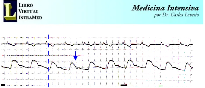 Fig. 16. Correlación entre el ECG y la onda de pulso arterial. Obsérvese el retardo entre el final  del QRS y el inicio del ascenso sistólico (línea punteada) y el punto de la onda dícrota (flecha).