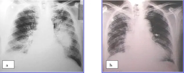 Fig. 6a. Radiografía de tórax de paciente con edema agudo de pulmón con componente alveolar