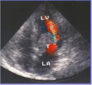 Fig. 1.- Ecocardiograma Doppler transtorácico que muestra un gran mixoma de aurícula izquierda en  un paciente con edema agudo de pulmón