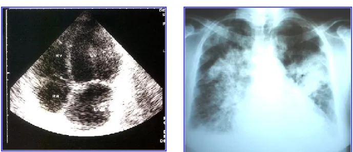 Fig. 3.- Miocardiopatía dilatada. Edema agudo de pulmón.