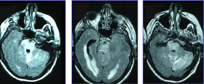 Fig. 1. Paciente con encefalopatía hipertensiva secundaria a patología renal. En la RMI secuencia 