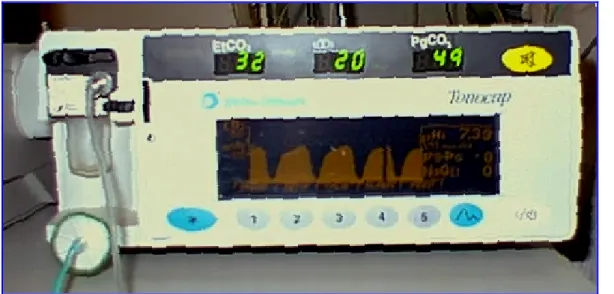 Fig. 11.- El dispositivo Tonocap 