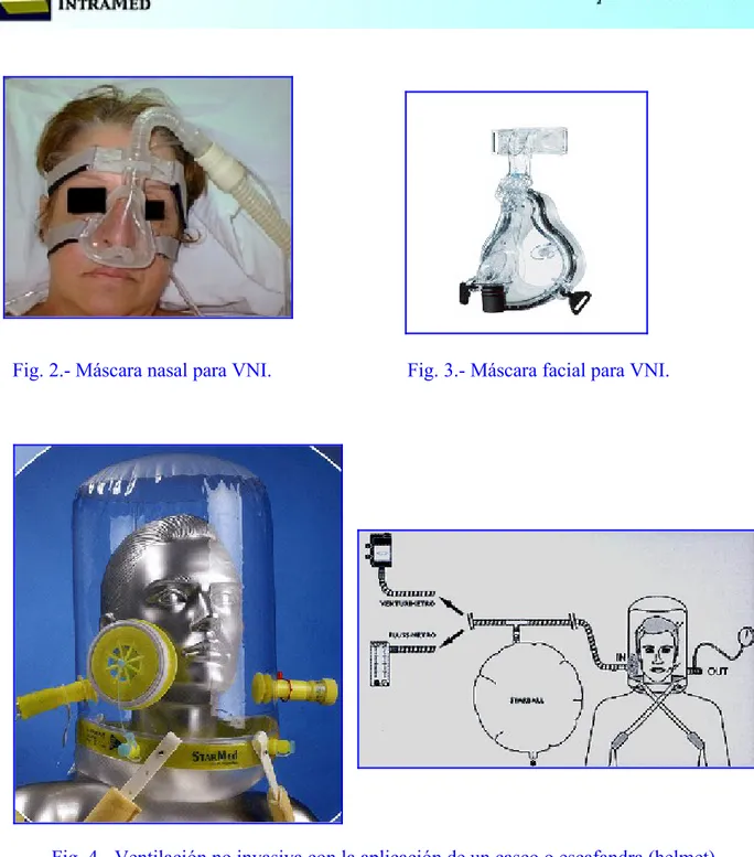 Fig. 4.- Ventilación no invasiva con la aplicación de un casco o escafandra (helmet).