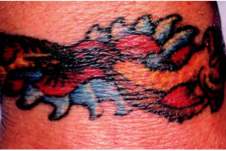 Fig. 2.  Tatuaje en la espalda de un paciente VIH+, que acude a visitarse por
