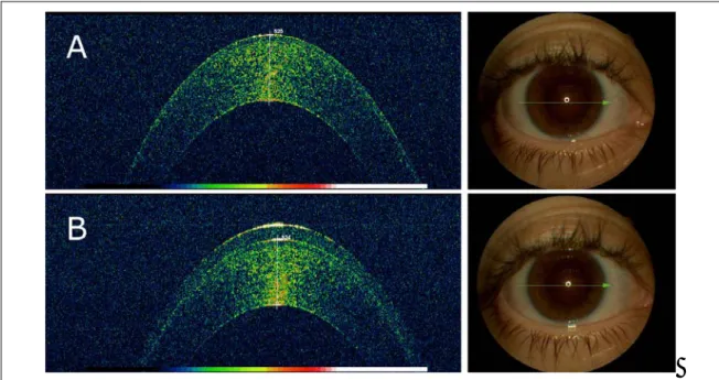 Figura 5.3.- Detalle del scan corneal con el OCT Topcon 3D OCT-1000. A.- Arriba izquierda se aprecia el  scan sin lente de contacto
