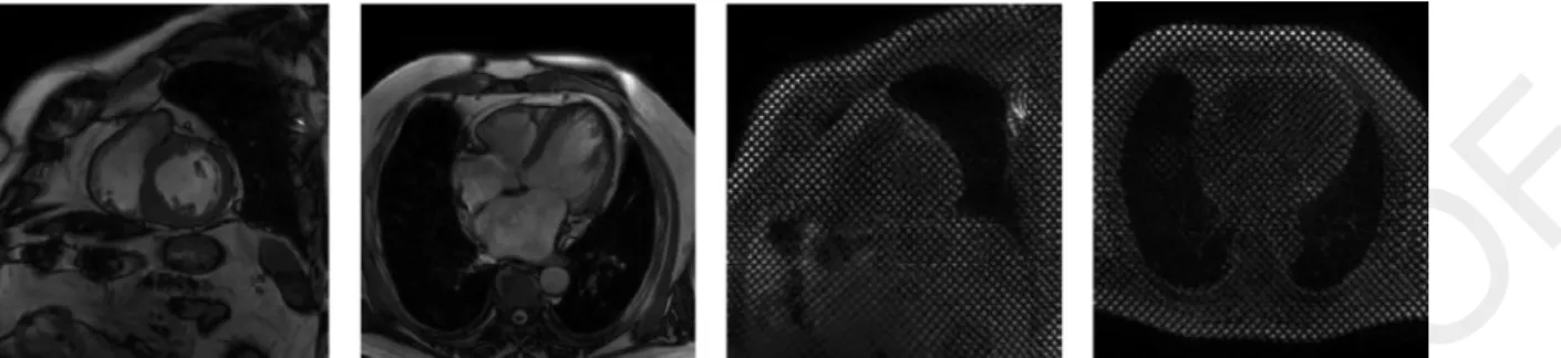 Fig. 1. Example images of the sequences acquired for the study. MR-Cine SA, MR-Cine LA, MR-Tagging SA and MR-Tagging LA, from left to right