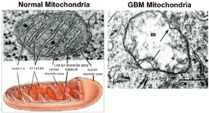 Fig. 2.  Typical ultrastructure of a normal mitochondrion and a mitochondrion  from a human glioblastoma