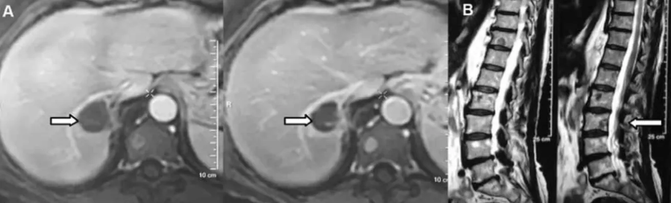 Figura 4 - Respuesta parcial bajo terapia con lenvatinib observada luego de 6 meses de tratamiento.