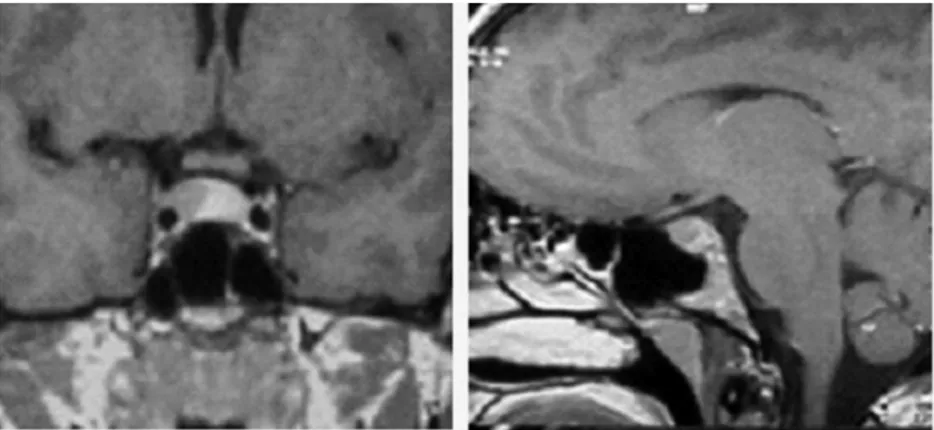 Figura 4. Caso 4. RNM (corte coronal y sagital) de la paciente n° 4, que muestra una imagen de 10 mm en 