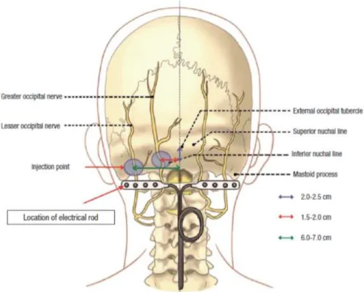 Figura 2 – Zonas de aplicación del anestésico y colocación de los electrodos de la  estimulación nerviosa occipital (ONS) 7 