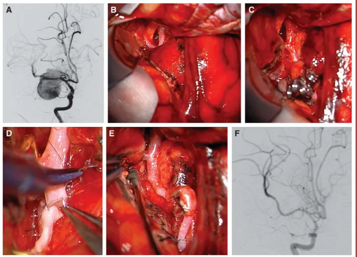FIGURE 1. A , a 7-year-old boy presented in coma with a subarachnoid hemorrhage from this giant, dolichoectatic M1 MCA aneurysm (digital subtraction angiography, right internal carotid artery injection, anteroposterior view)