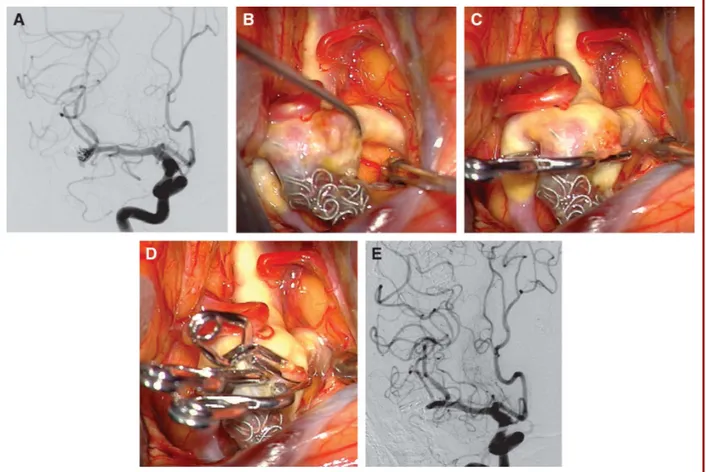 FIGURE 2. A , a 69-year-old woman with a left MCA aneurysm was initially treated with coiling and her aneurysm recurred 6 months later, as seen on surveillance angiography (digital subtraction angiography, right internal carotid artery injection, anteropos