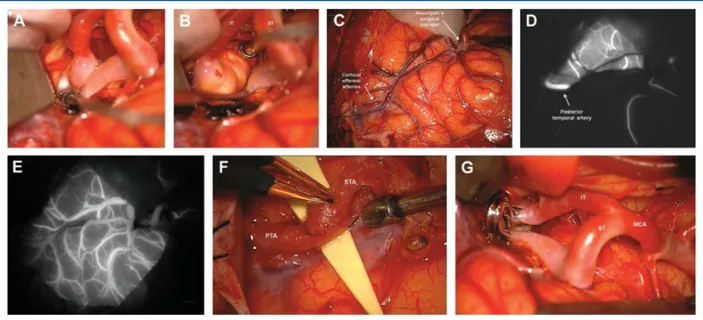 FIGURE 2. Case 1, intraoperative photographs. A wide splitting of the sylvian fissure showed the superior and inferior MCA trunks (ST, IT) coursing deep into the insular recess ( A ) and the fusiform aneurysm (*) arising from the inferior trunk ( B )