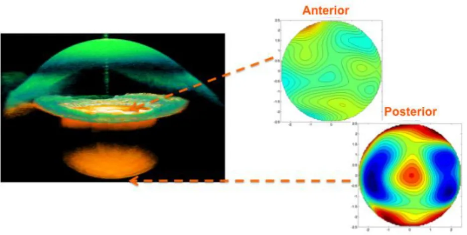 Figure 1.2. 3-D in vivo anterior segment volume and the corresponding crystalline 