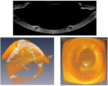 Figure 1.14. (Top) OCT cross sectional image showing the ICRS inside the cornea. 